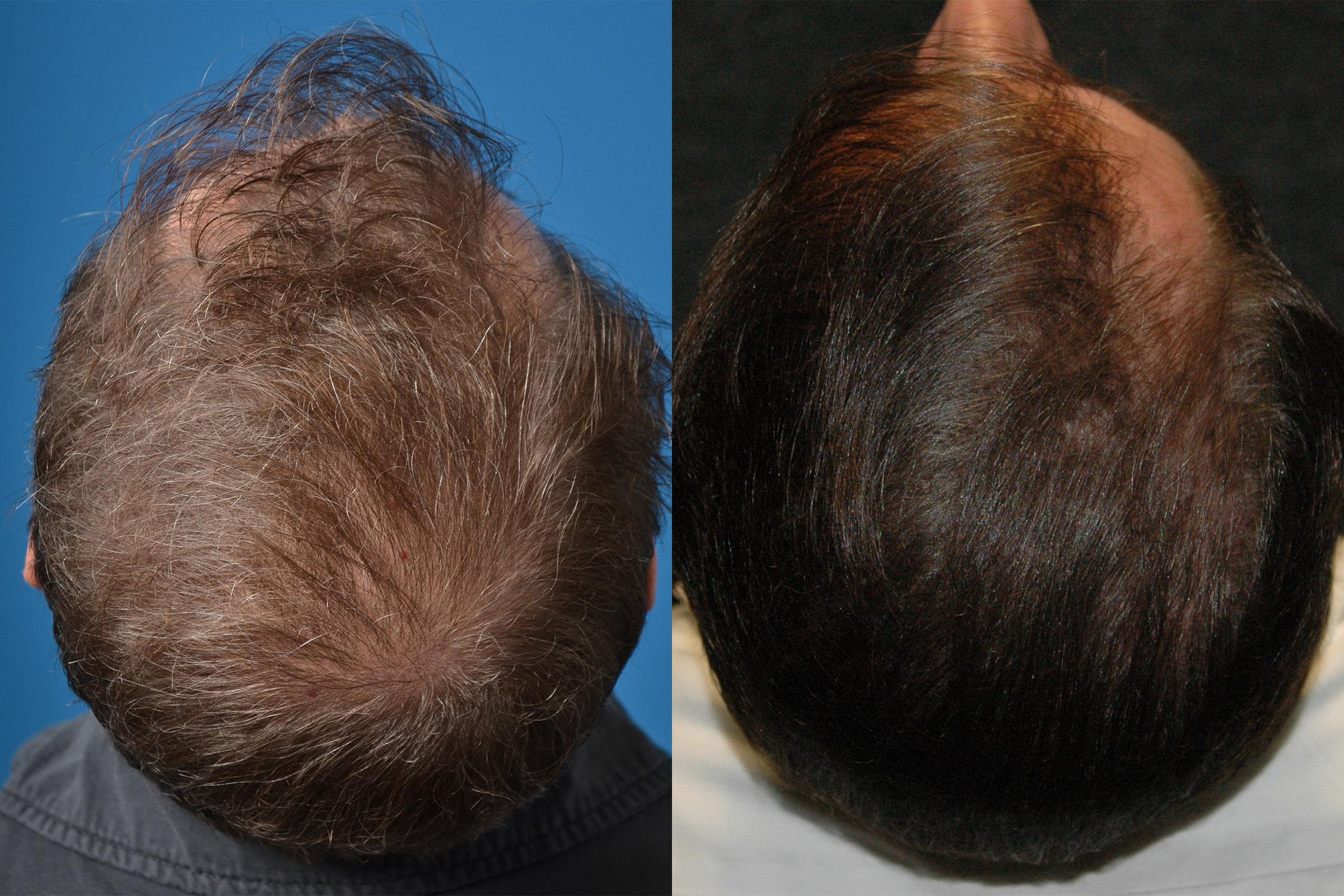 Hair Restoration Photos Melbourne, FL Patient 52059